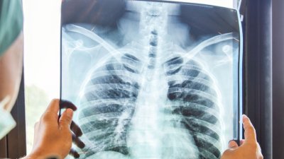 Ómicron, ¿afecta los pulmones?